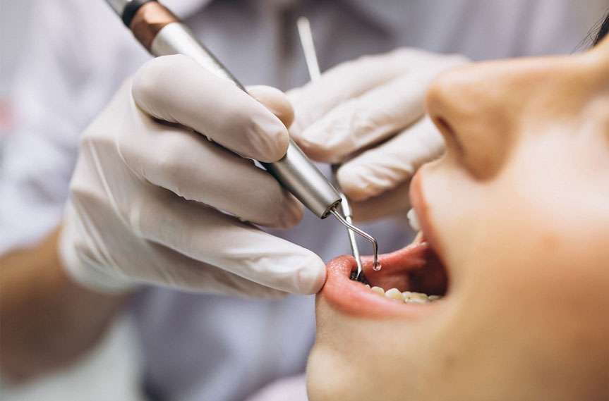 veneer teeth shaving