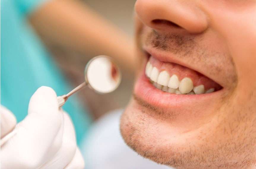 veneer teeth shaving