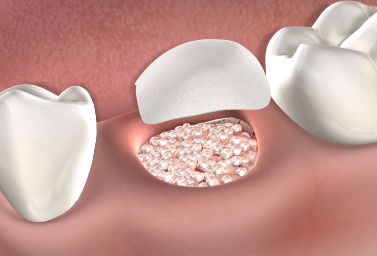 bone graft for dental implant