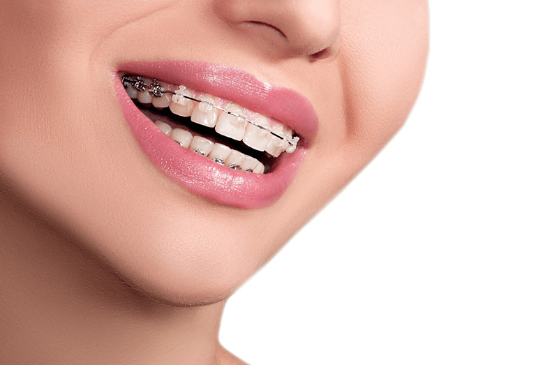 teeth extraction for braces