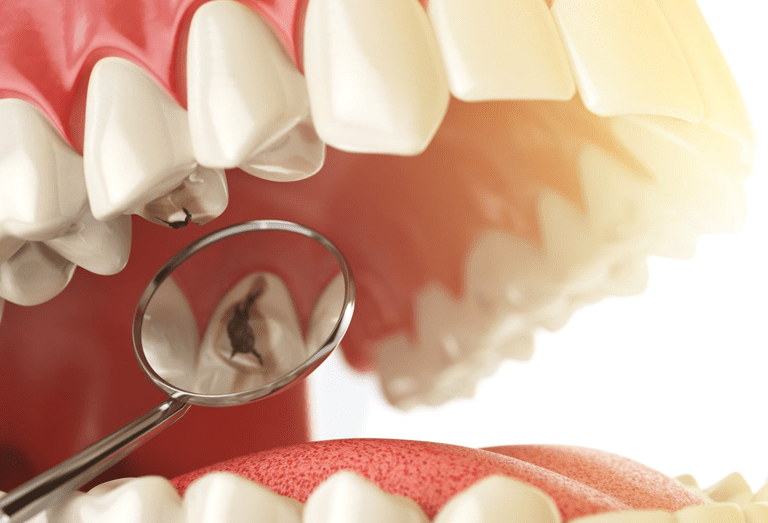 Cavity Dental Filling