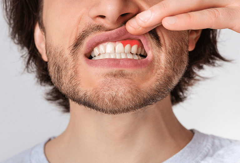 Tooth Abscess Pain Relief Fast