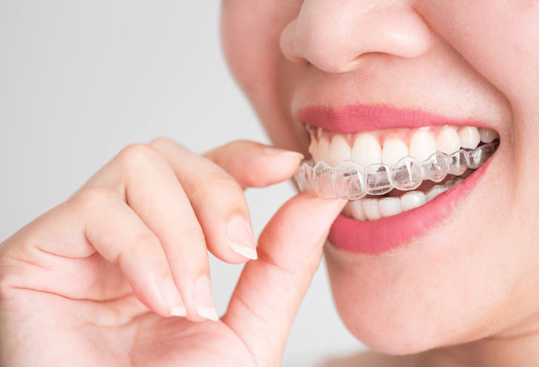 cheap invisalign