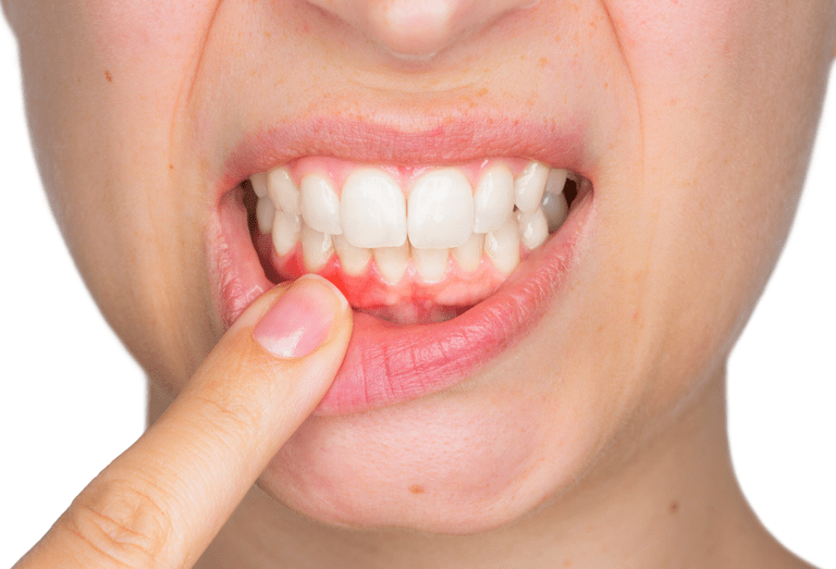 Receeding Gum Treatment