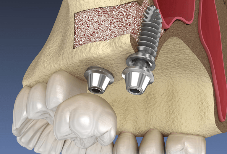 Sinus Lift For Implant