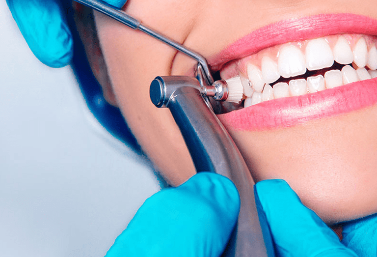 Tooth Decay Cleaning