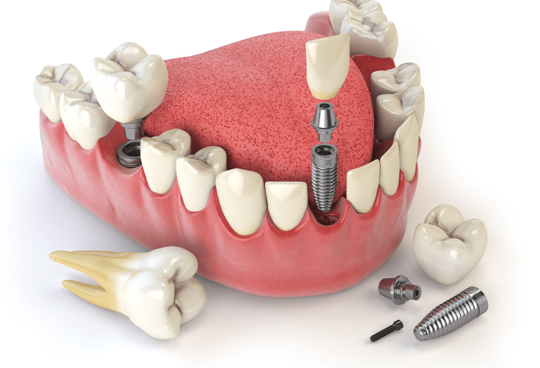 why-need-dental-implants